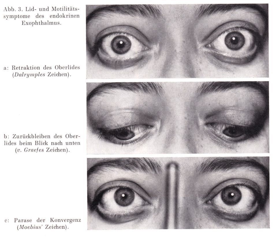 Exophthalmus: Klinik