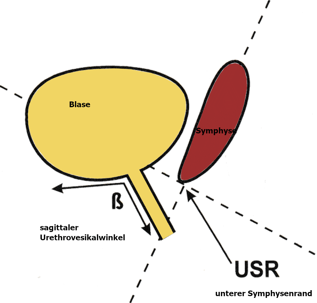 Urethrozystographie