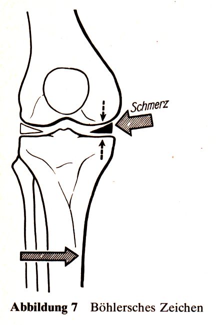 Böhlersches Zeichen