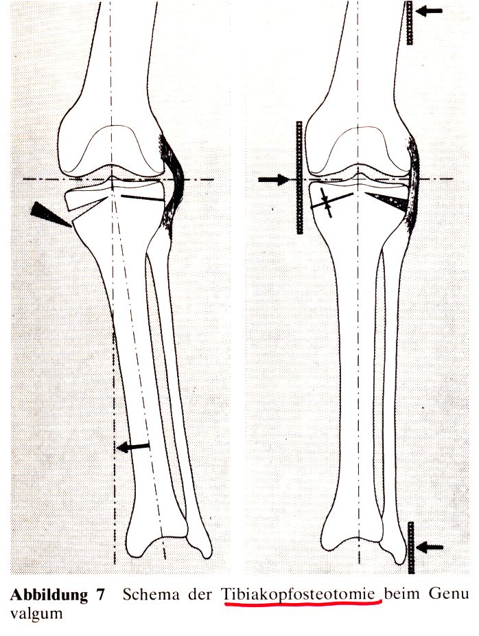 Korrektur des Genu valgum