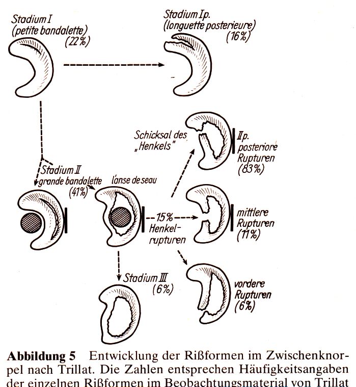 Art der Meniskusverletzung