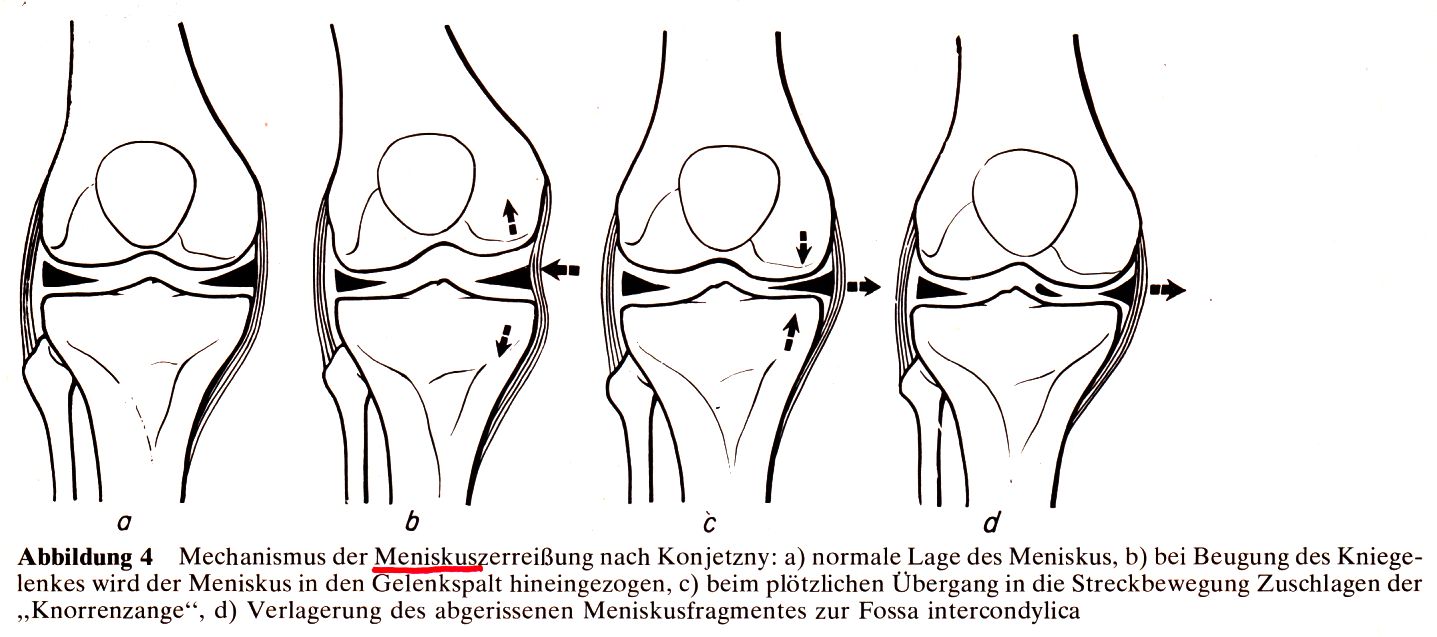 Verletzungsmechanismus