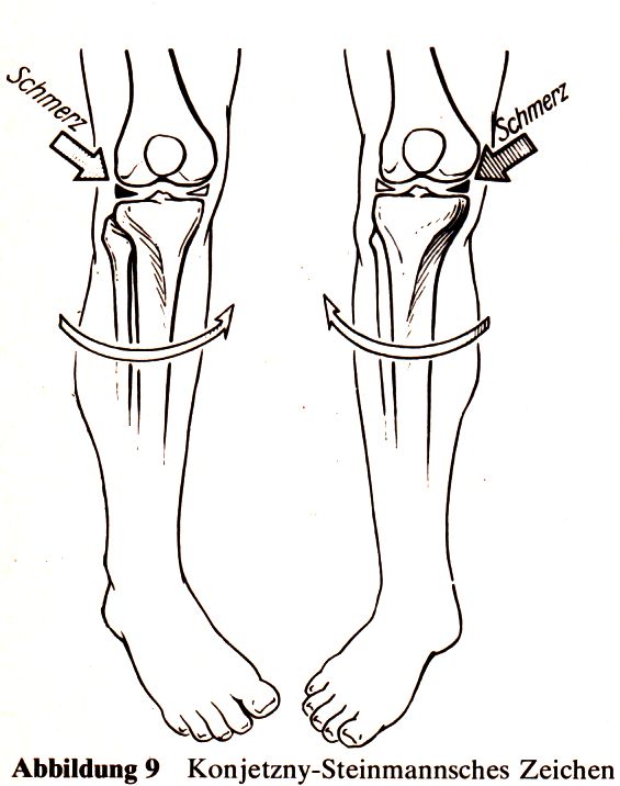 Steinmann I