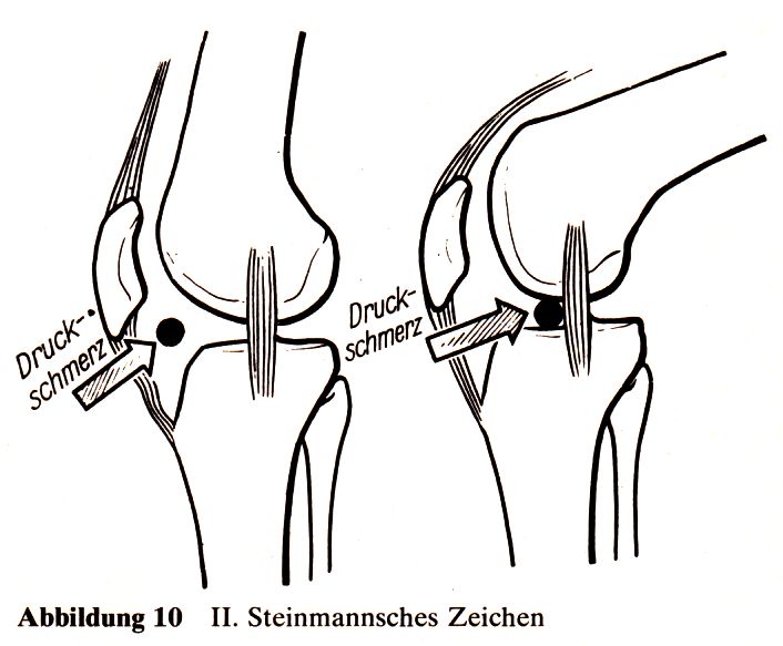 Steinmann II