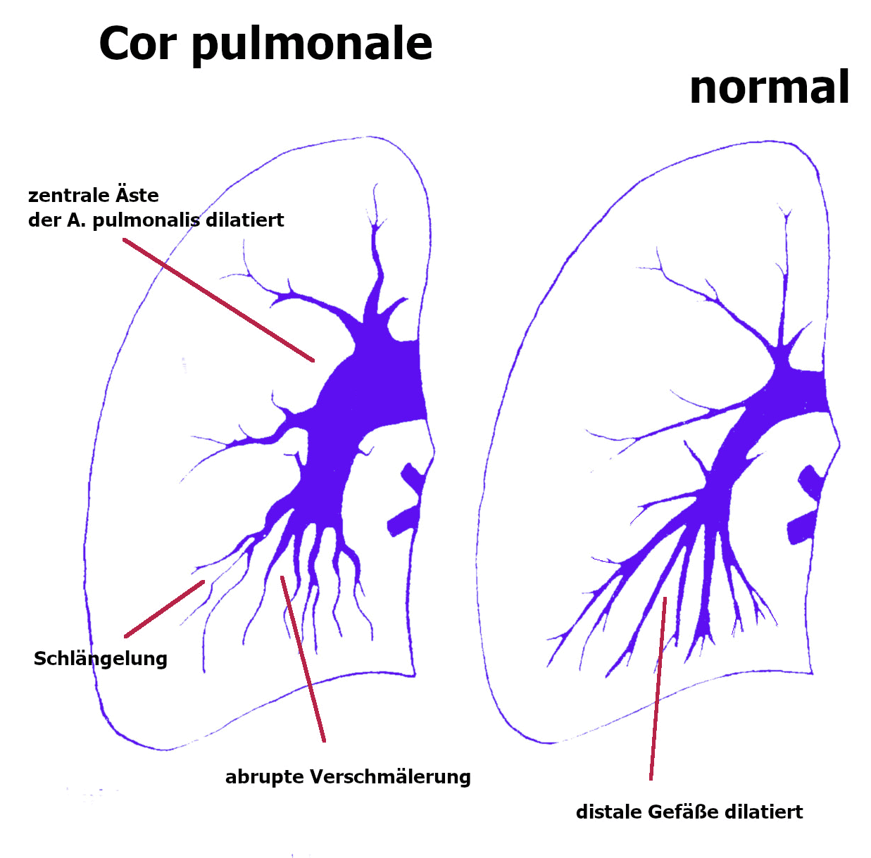 Cor pulmonale