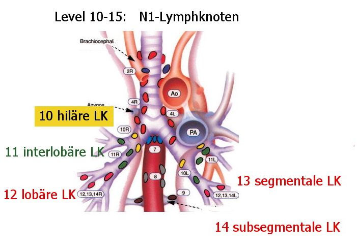 N1-Lymphknoten
