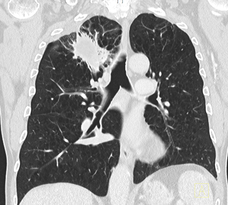 NSCLC re OL