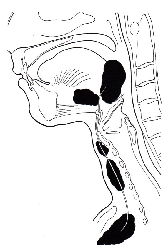 Thyreoglossale Zysten