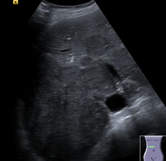 Diagnostik des HCC