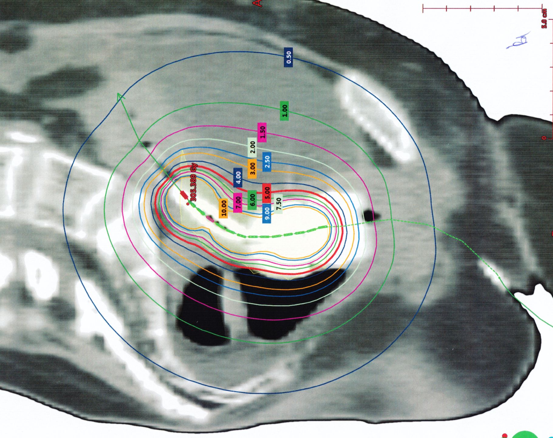 intrauterin