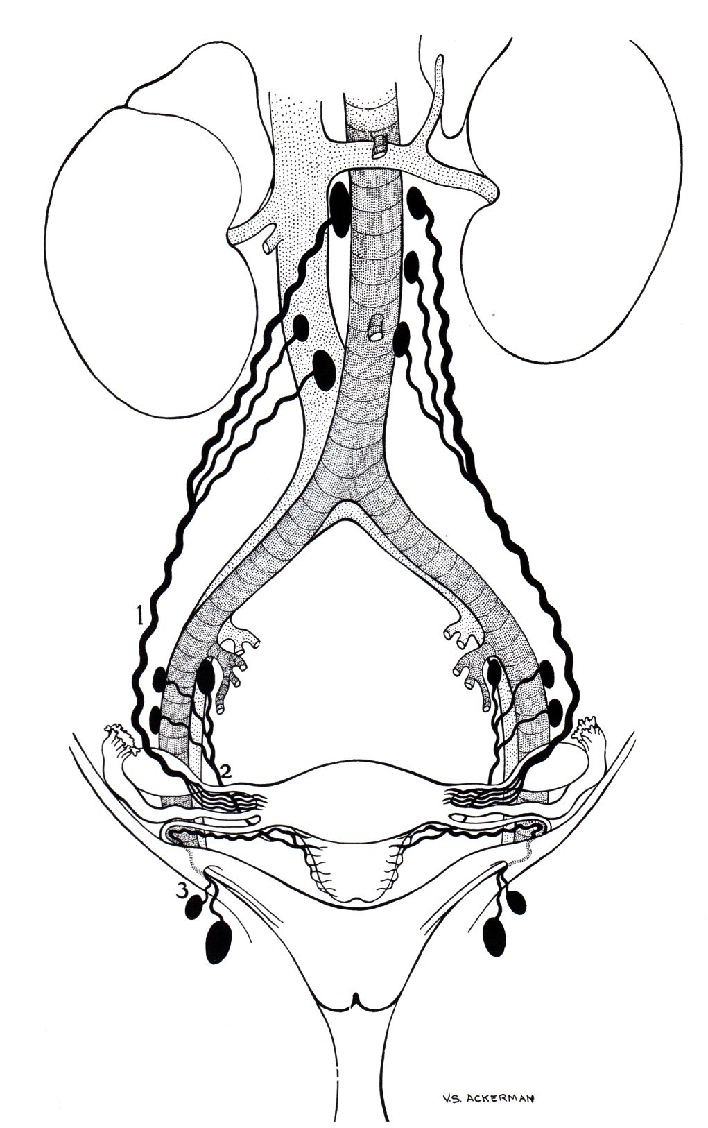 Lymphabfluss des Endometrium Karzinoms