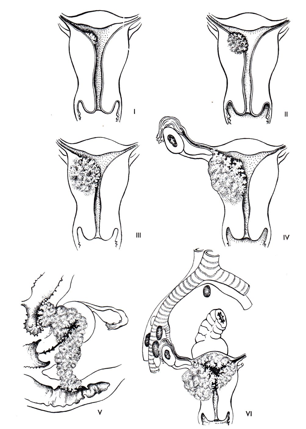 Ausbreitung des Endometrium- Karzinoms