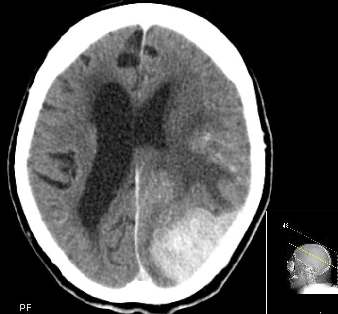 Hirnmetastase