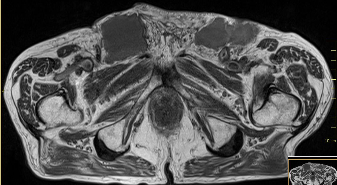 Lymphknotenmetastasen bei Peniskarzinom